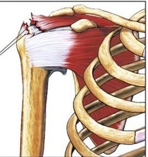 Rách gân cơ chóp xoay khi chơi tennis
